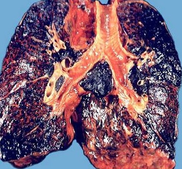 tar lungs (2)